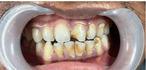 Severely worn or discoloured teeth